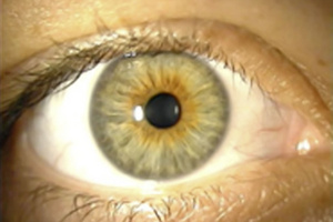 Irisdiagnose Irisdiagnose